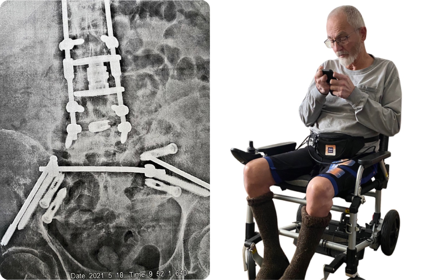 Patient wears BioShorts to control pain